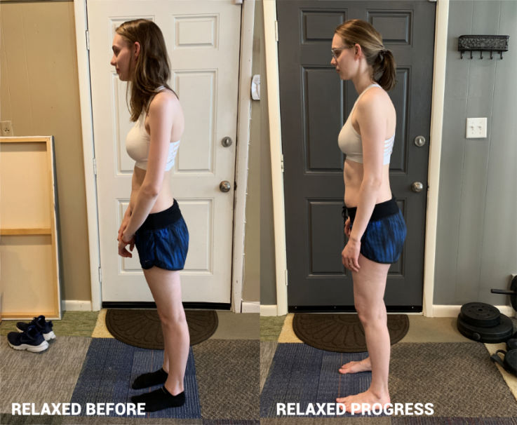 Scoliosis, poor posture, lack of confidence - Chattanooga, Nashville, Atlanta, Knoxville, Cleveland